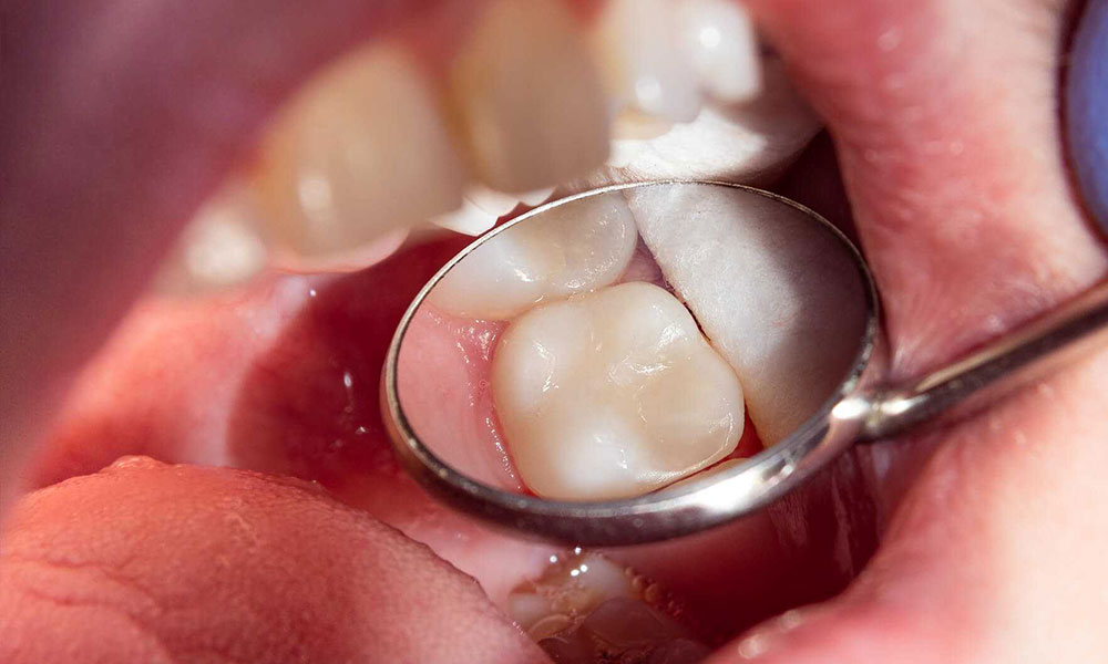 دندان دائمی