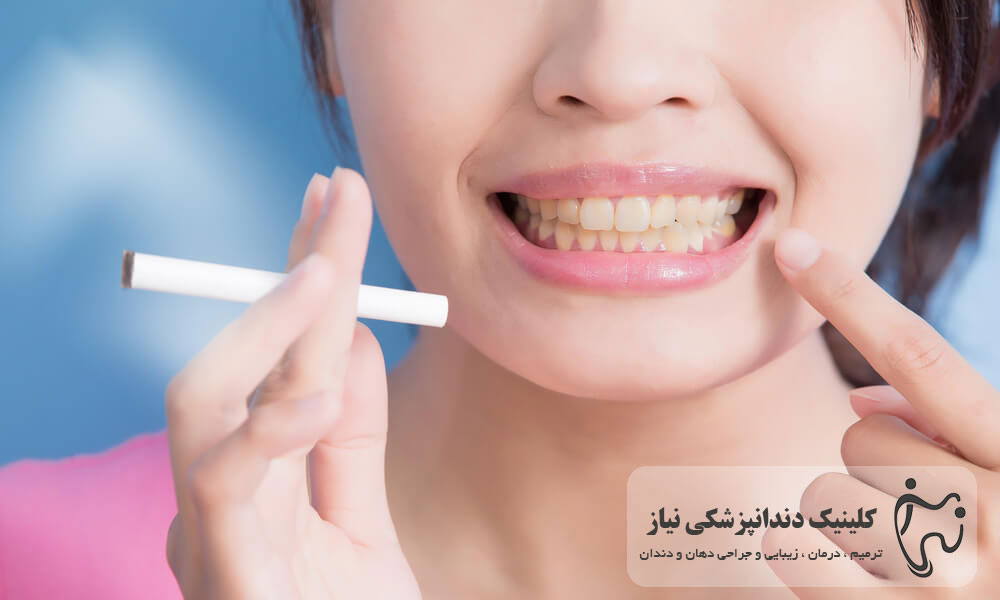 سیگار و دخانیات دشمن ماندگاری بلیچینگ