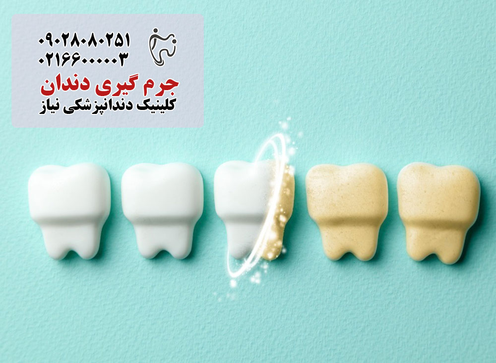 جرم گیری دندان