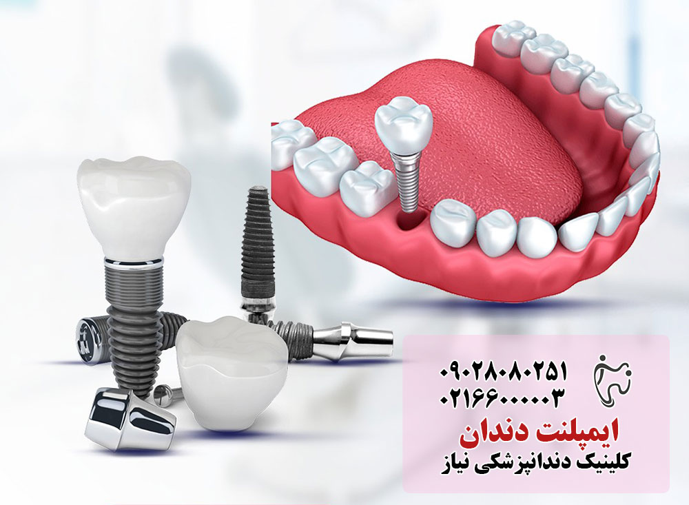 دستورات لازم بعد از جراحی ایمپلنت