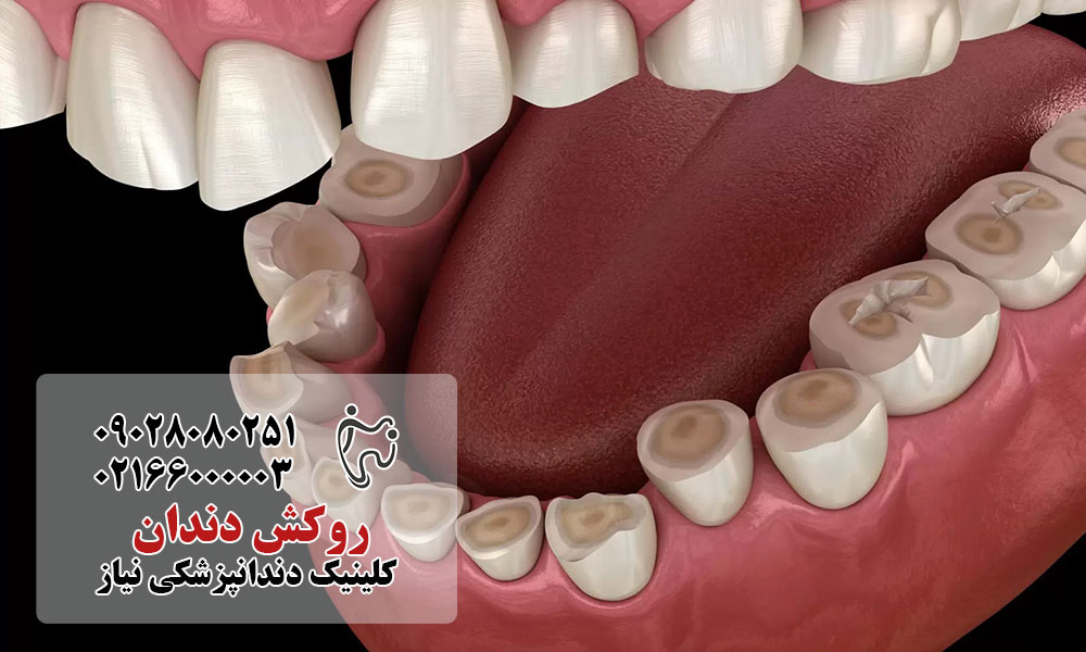 روکش درمان فرسایش مینای دندان