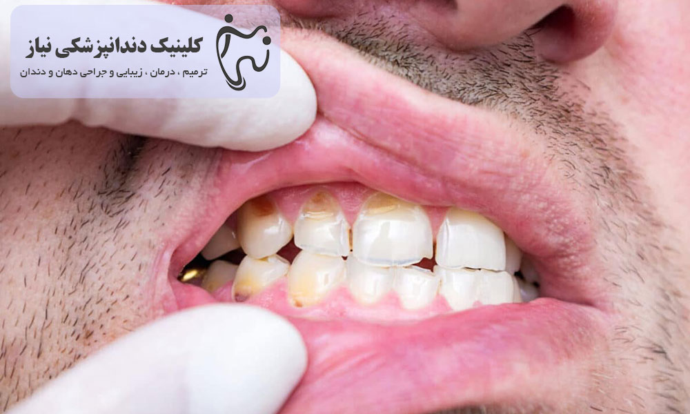 علل فرسایش مینای دندان