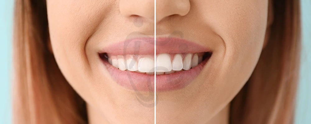 عوارض کانتورینگ لثه