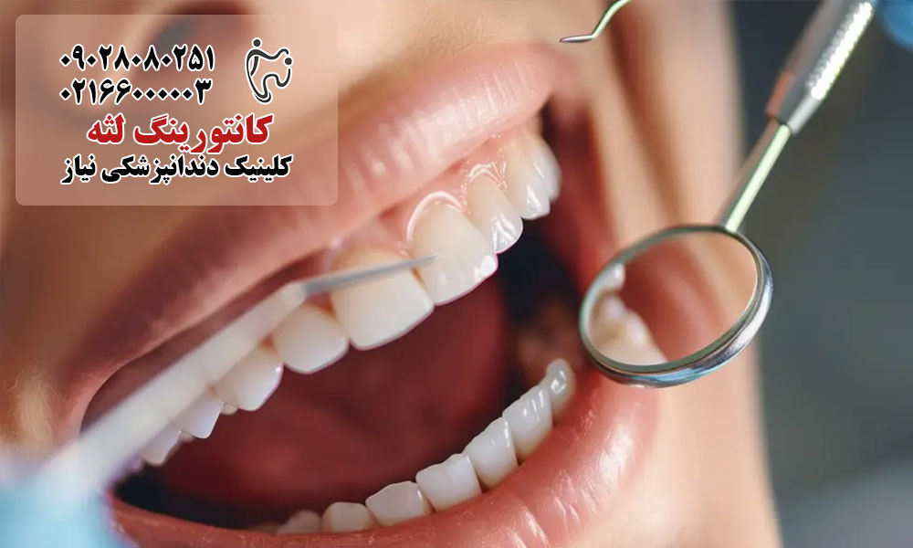 مراقبت های پس از کانتورینگ لثه