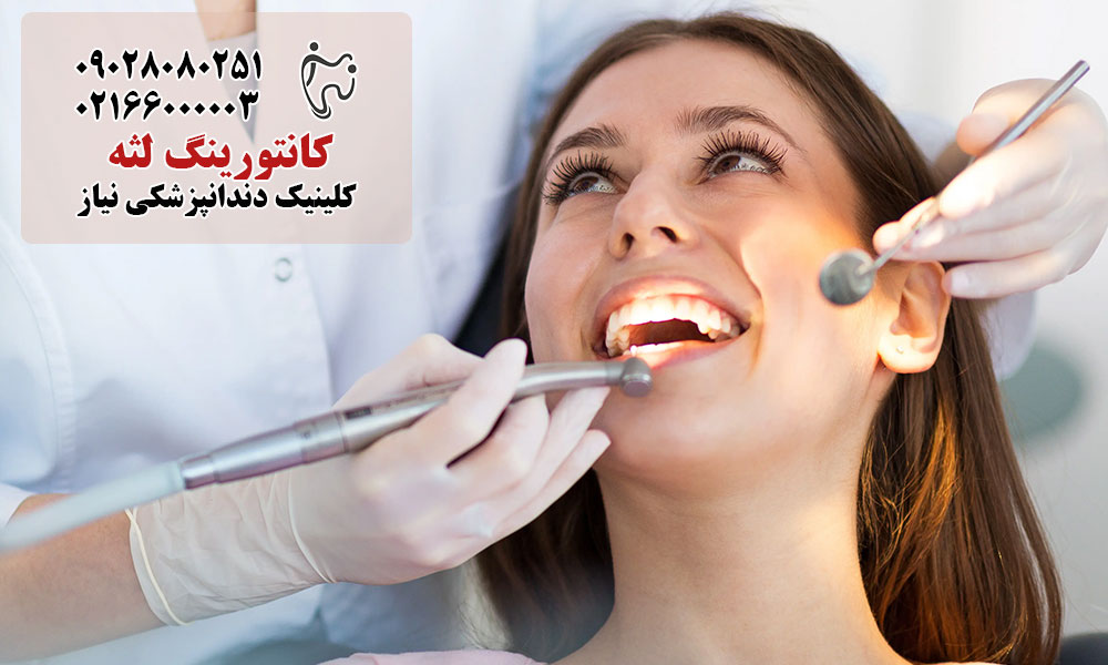 مزایای کانتورنیگ لثه