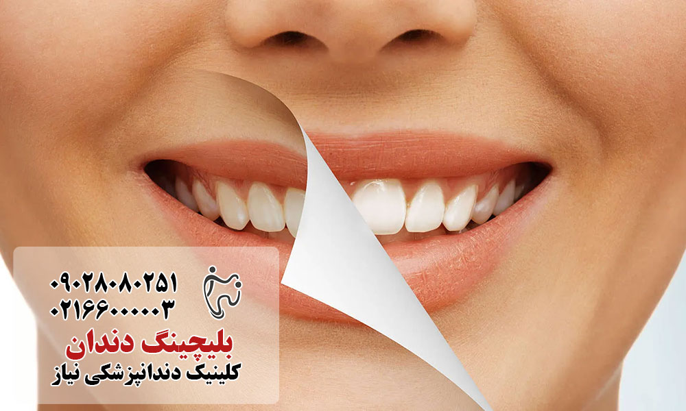 بلیچینگ دندان