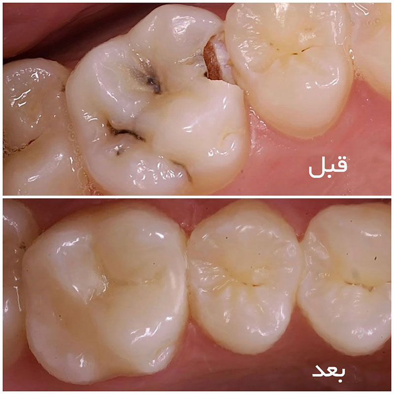 قبل و بعد پر کردن دندان