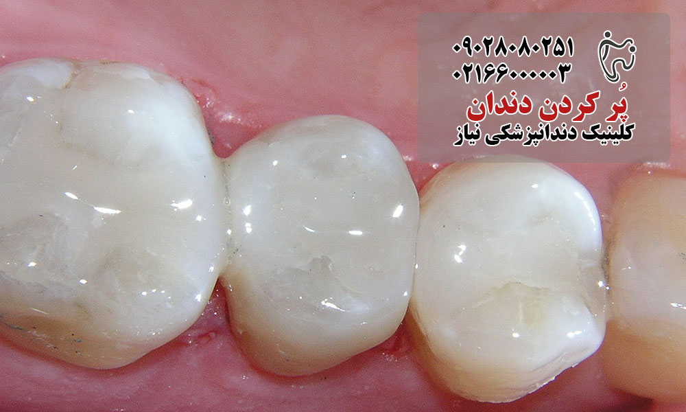 مراقبت از دندان پر شده
