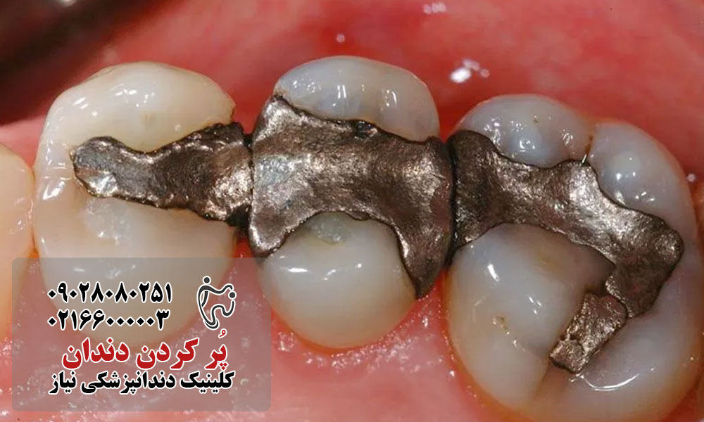 پر کردن آمالگام دندان