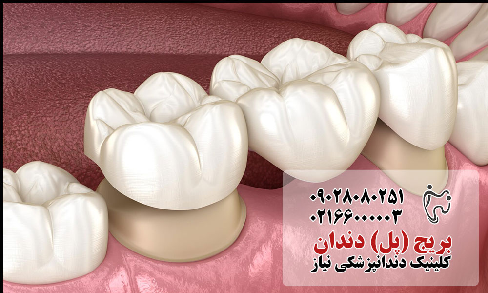 بریج (پل) دندان