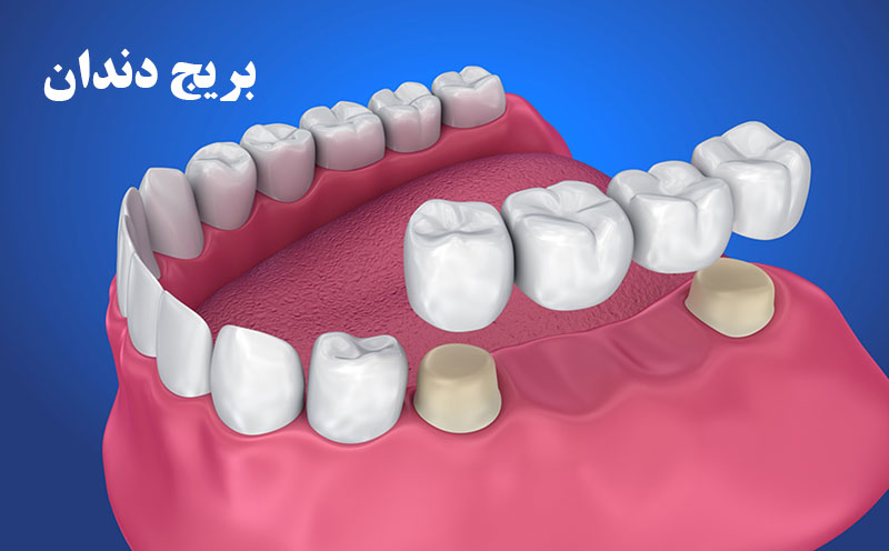 بریج دندان