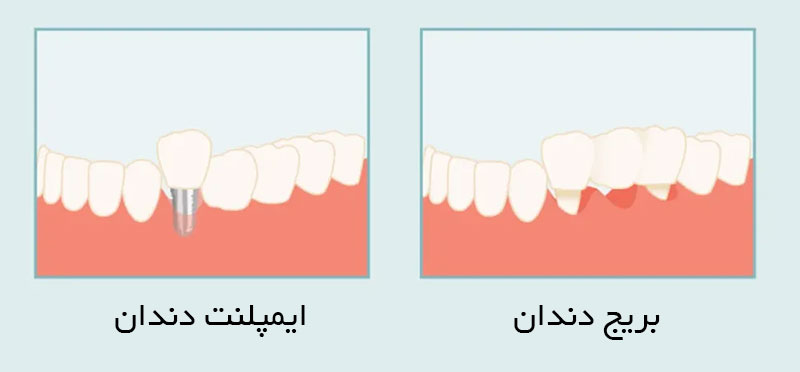 تفاوت ایمپلنت و بریج دندان