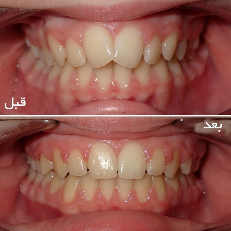 قبل و بعد ازتودنسی لینگوال