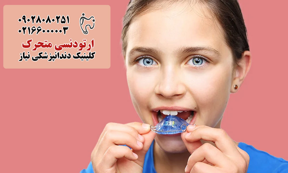 مزایای ارتودنسی متحرک