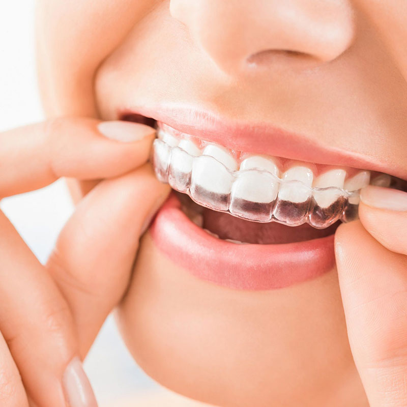 مزایای بریس متحرک