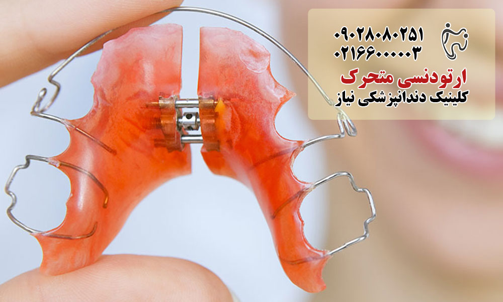 کاربرد ارتودنسی متحرک