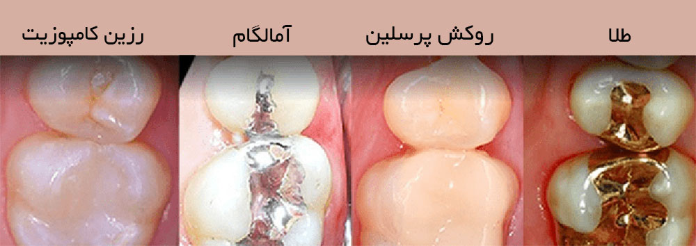 انواع مواد پر کردن دندان