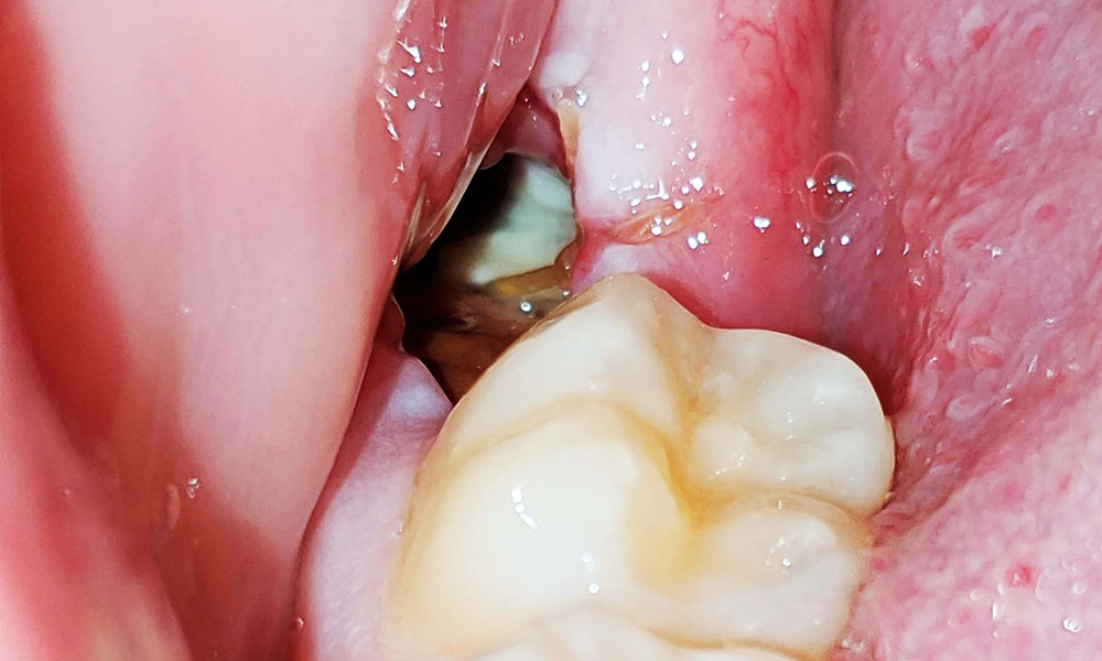 علائم حفره خشک