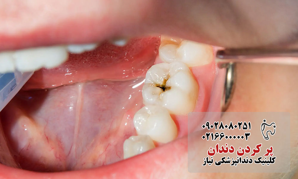 علائم هشدار حفره دندانی