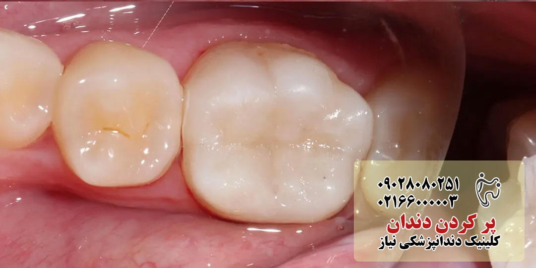 مدت زمان پر کردن دندان