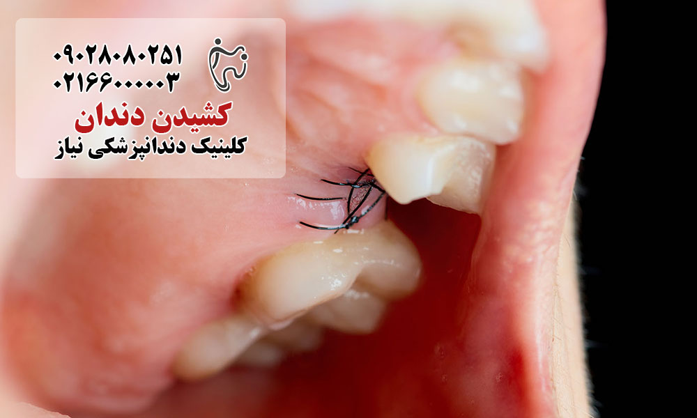 نقاهت پس از کشیدن دندان