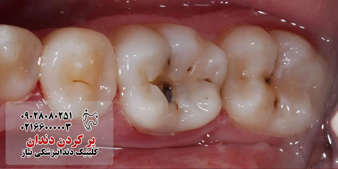اندازه و عمق حفره دندان