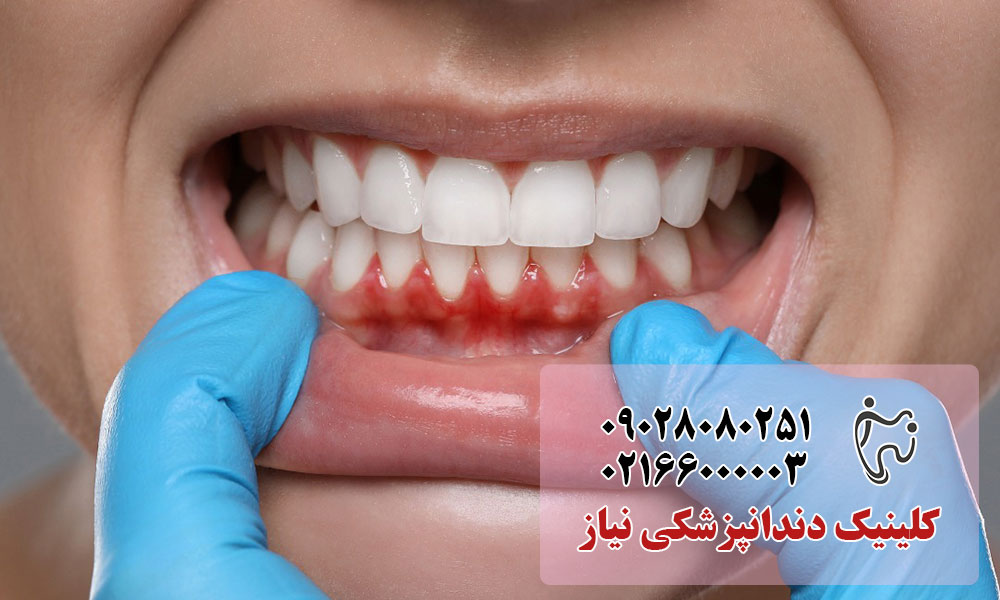 انواع مختلف جراحی لثه