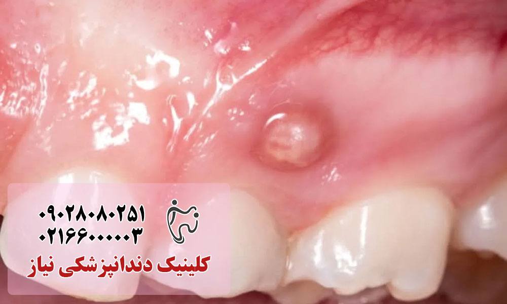 بیماری پریودنتال