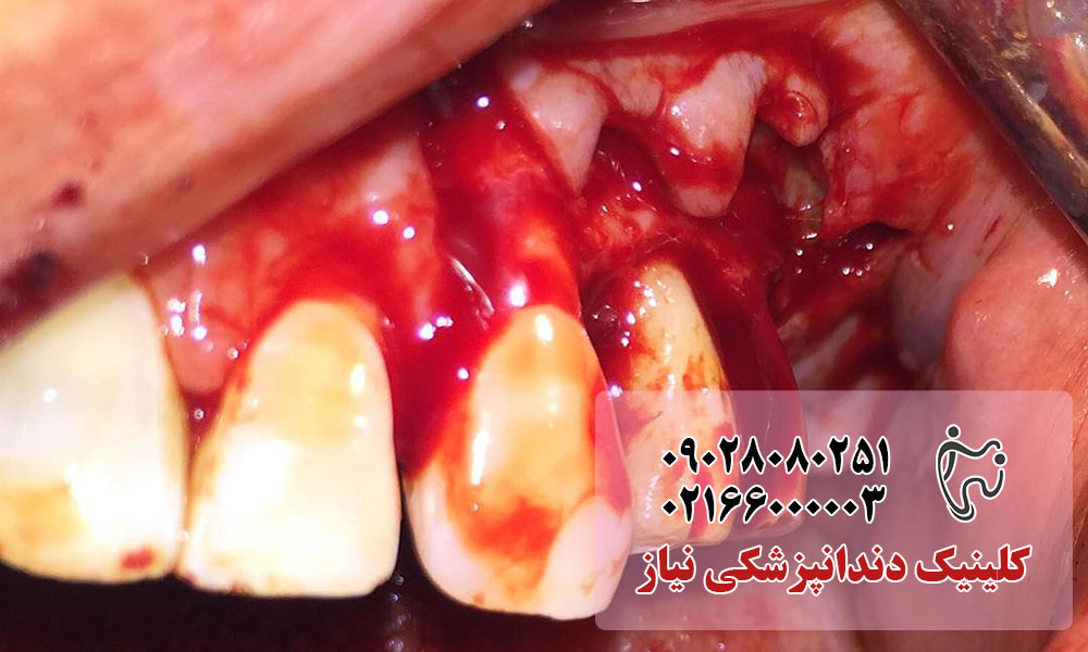 جراحی پریودنتال