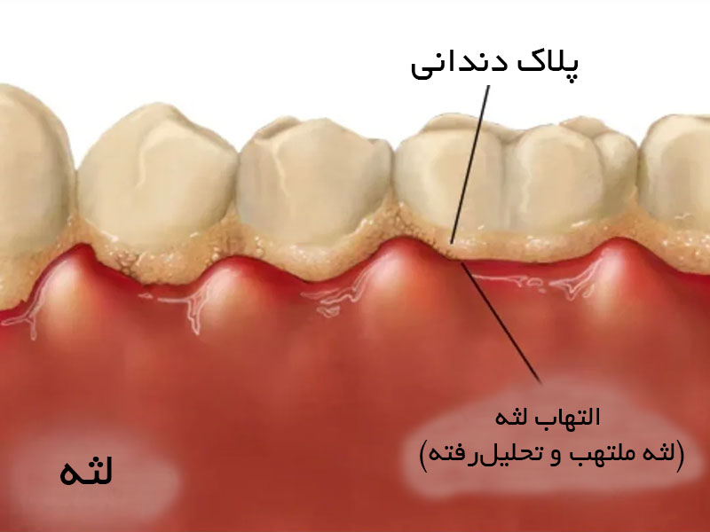 علل التهاب لثه
