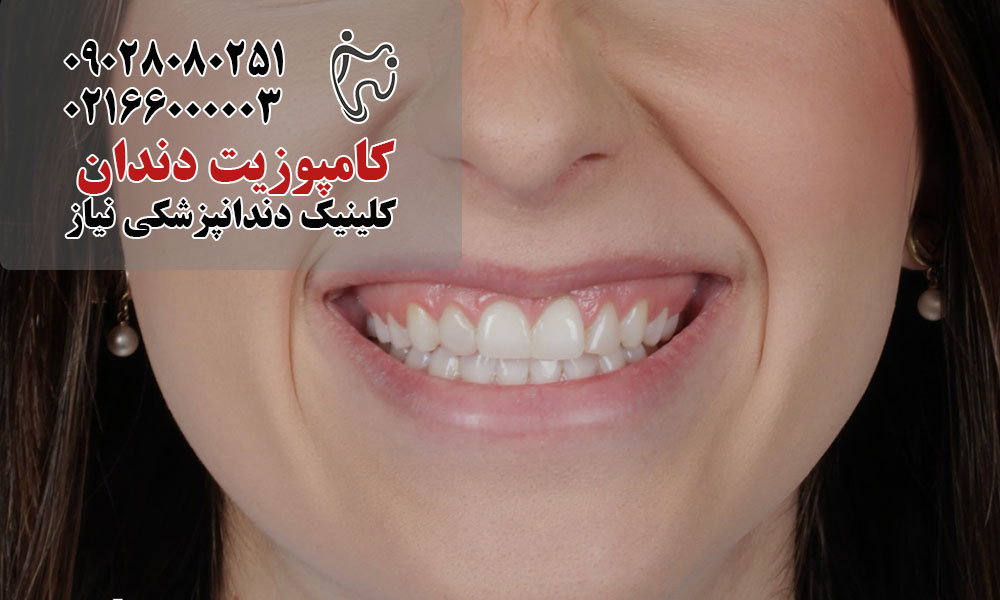 کامپوزیت دندان