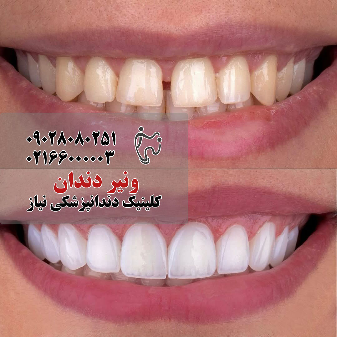 عکس قبل و بعد از ونیر دندان