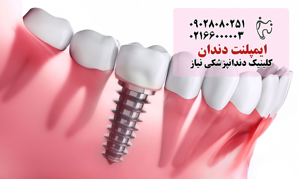 ایمپلنت دندان در تهران