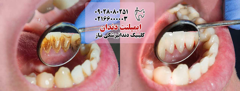 بعد از جرم‌گیری دندان