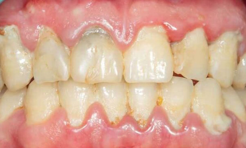 بیماری پیشرفته لثه