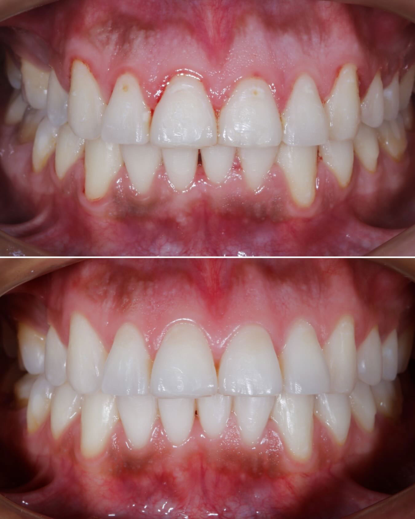 درمان التهاب لثه