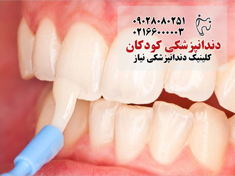 درمان فلوراید