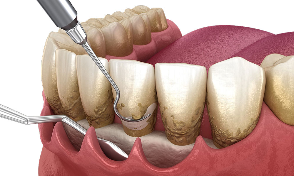 درمان پریودنتیت
