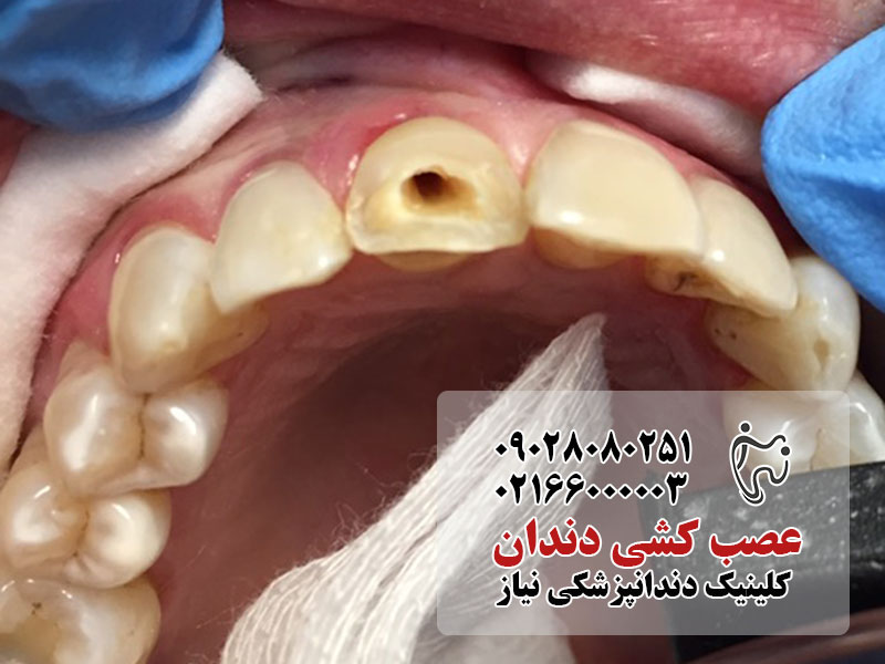 روش عصب کشی دندان جلویی