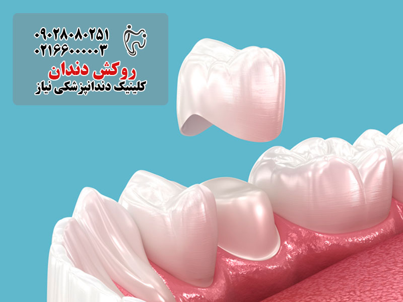 روکش دندان چند روزه