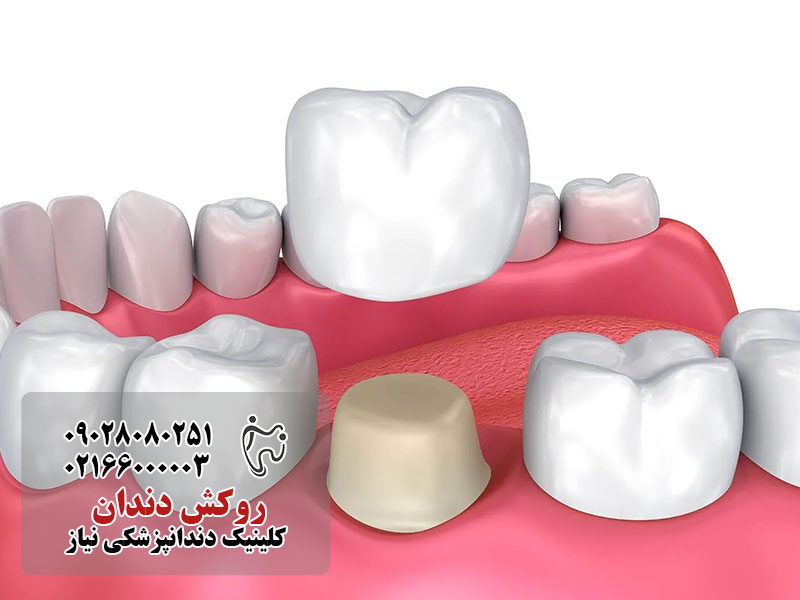 روکش دندان یک روزه