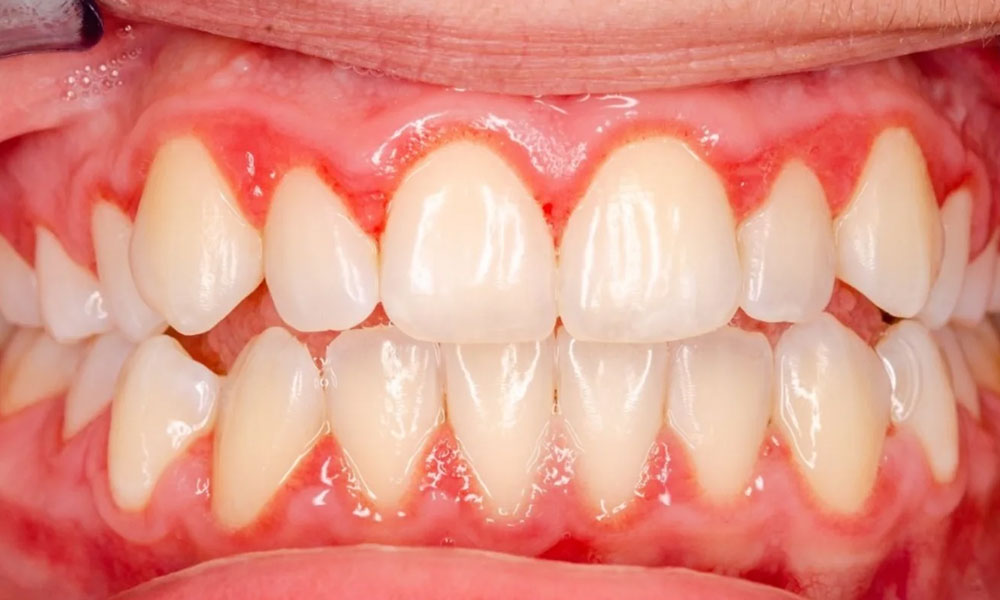 سوالات متداول التهاب لثه