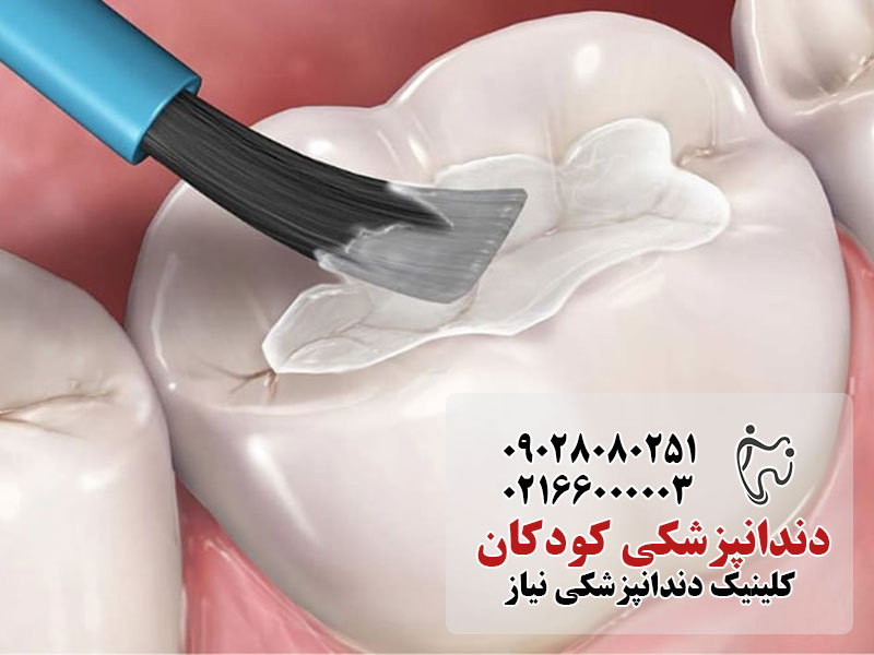 سیلانت‌ دندانی