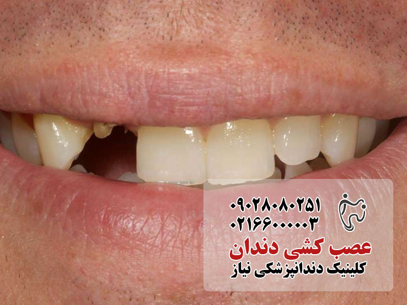 عصب کشی دندان 