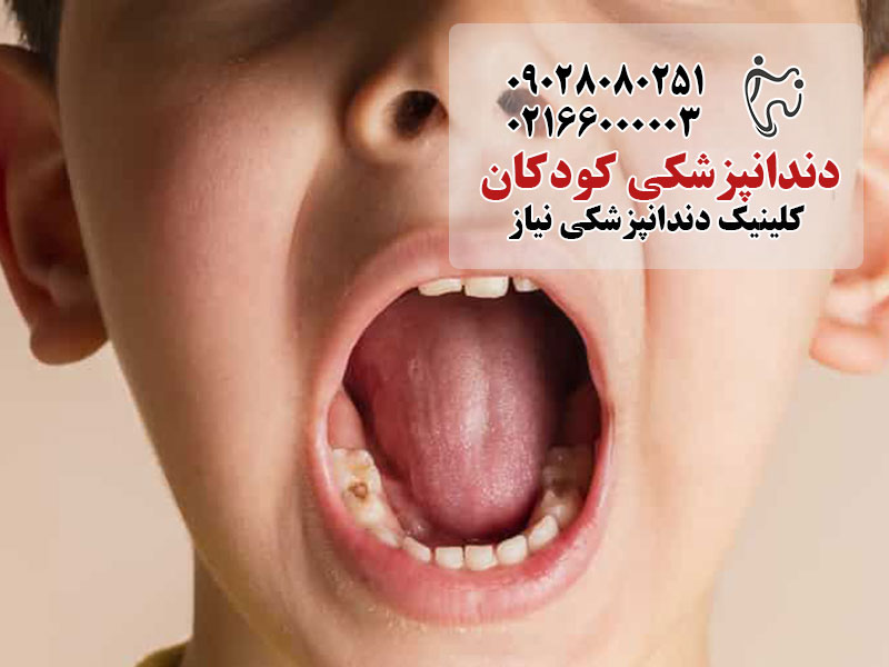 علل پوسیدگی دندان در کودکان