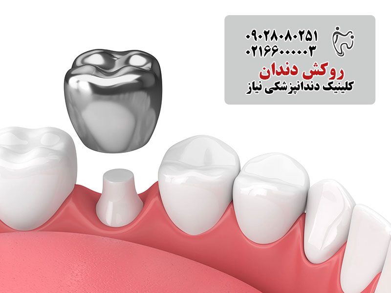 عوارض روکش دندان