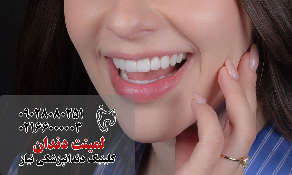 لمینت دندان
