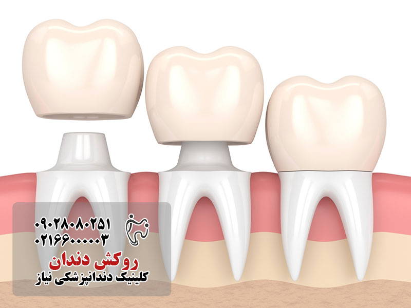 مراحل روکش دندان