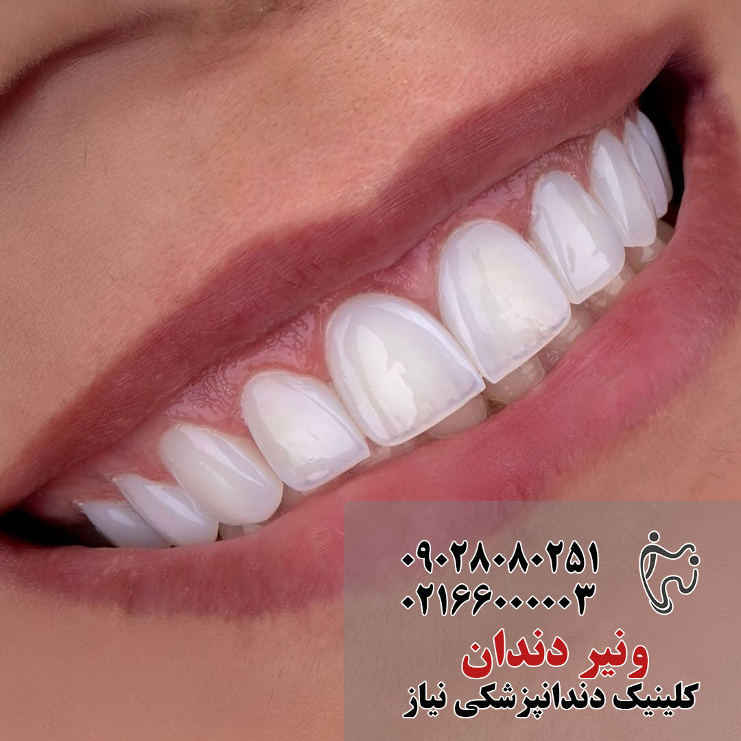 مزایای ونیر دندان