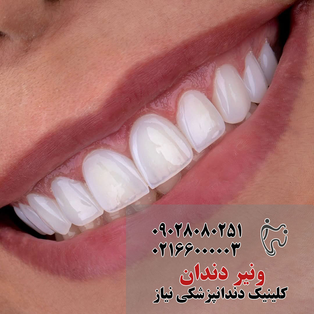 ونیر لمینت دندان